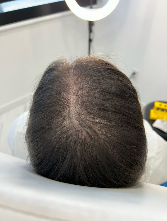 PRP TREATMENT HAIR RESTORATION SURREY BC 604-996-3373