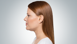 Before Kybella treatment