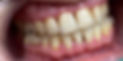 Pacient tratat de parodontoza cu ajutorul laserului dentar