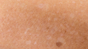 White Spots and Spray Tanning