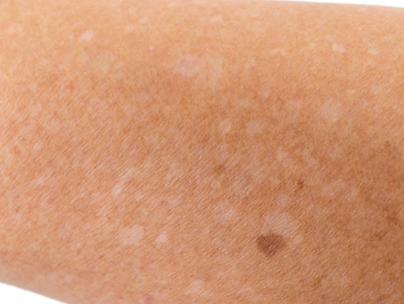 White Spots and Spray Tanning