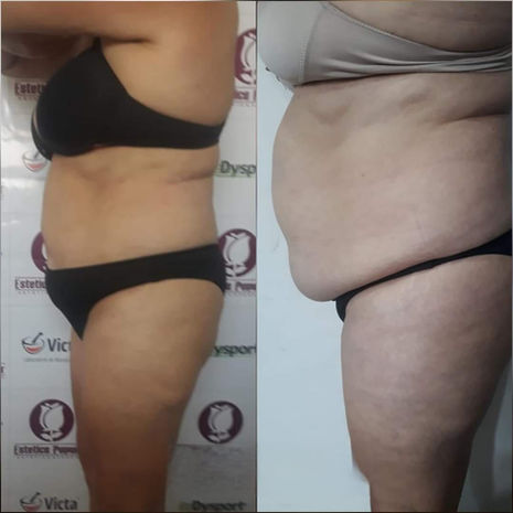 Emagrecimento Advanced Estetica Taboão da Serra