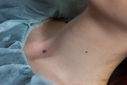 Operation to install micro-dermal pierci
