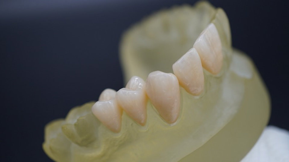 ☆ジルコニア☆を歯科技工所が説明