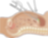 Laparoscopia