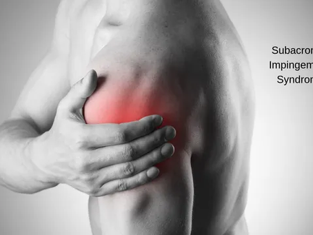 Shoulder Impingement