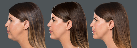 kybella dallas