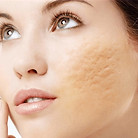 acne-inicial-768x589%20(1)_edited.jpg
