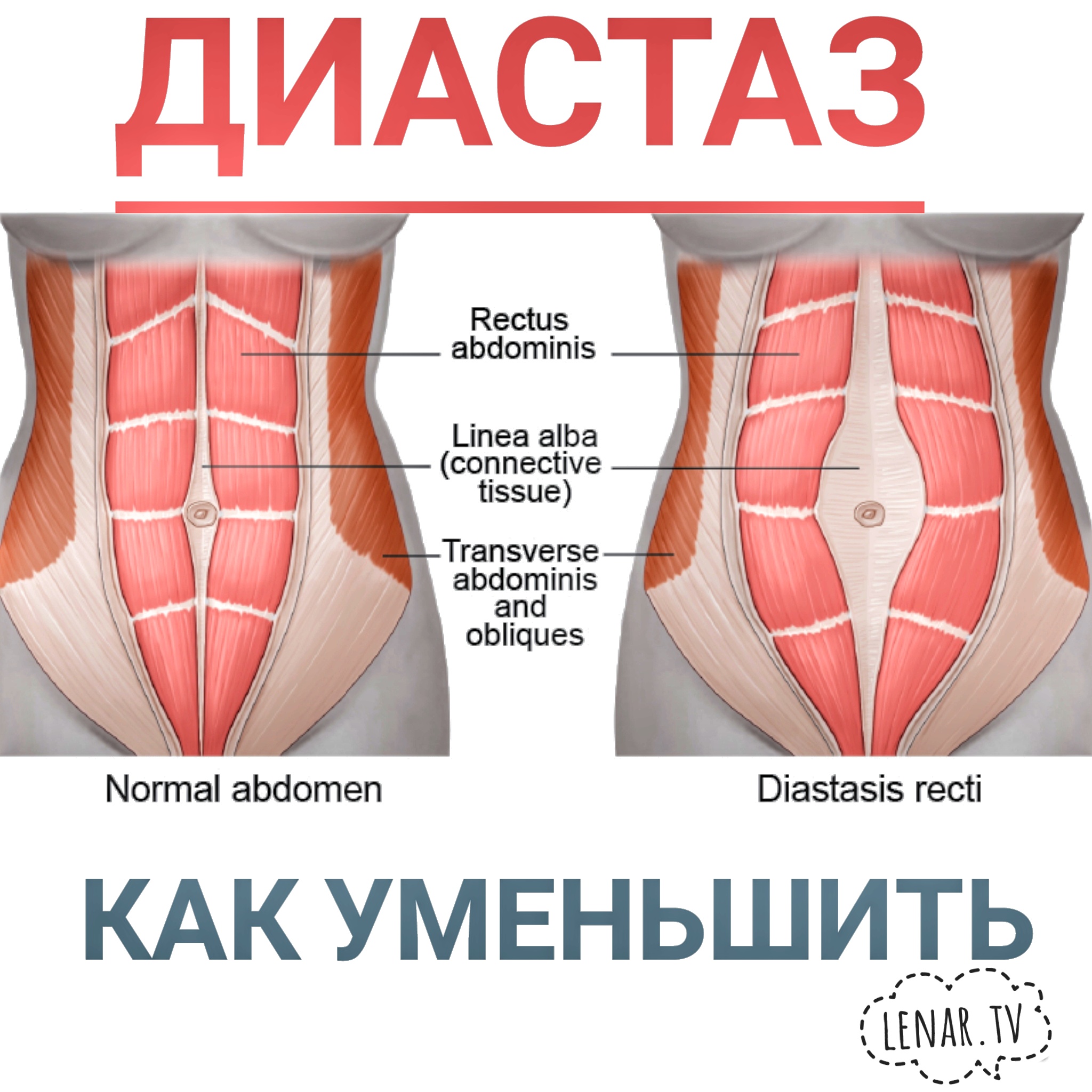 Что Такое Диастаз Фото