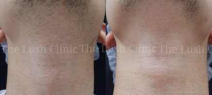 thelushclinic Hair Removal before after 04