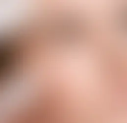 Botox vs. Fillers: Which is Right for You in Dubai?