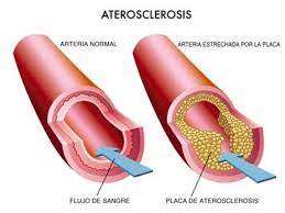Arterosclerosis
