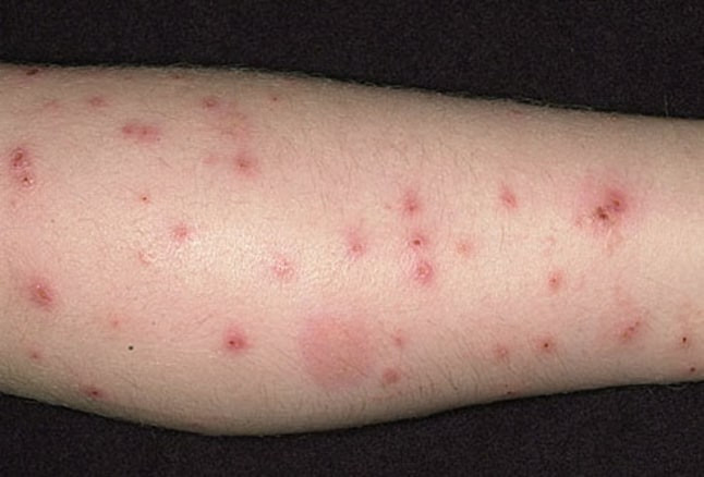 flea bites