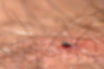 tick embedded in human skin, bug bites identified by sterifab