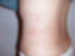 flea bites on torso, identifying bug bites