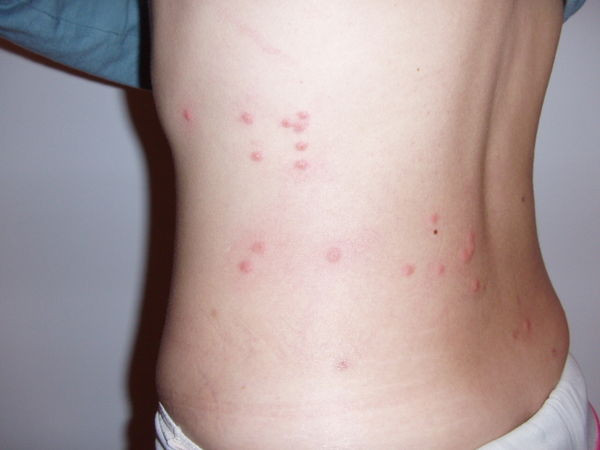flea bites on torso, identifying bug bites