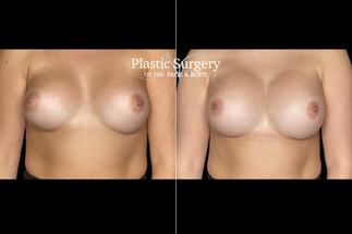 Removal/Replacement of Implants