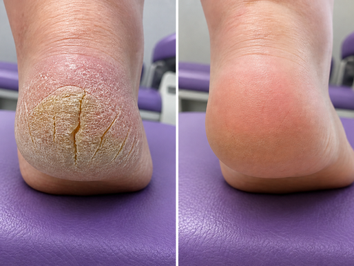 Go From Dry Cracked Heels to Stepping Out Sandal-Ready