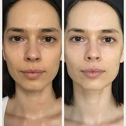 JetPeel Before & After, treatment offered in Buffalo NY