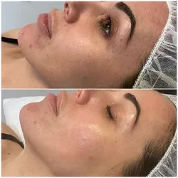 JetPeel Before & After, treatment offered in Buffalo NY