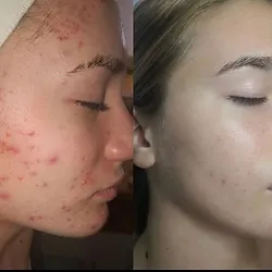 JetPeel Before & After, treatment offered in Buffalo NY