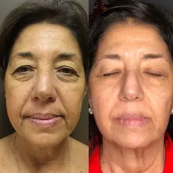 JetPeel Before & After, treatment offered in Buffalo NY