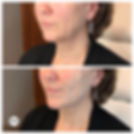 Non surgical face lift, thread lift