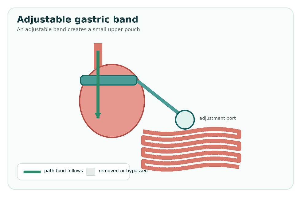 Adjustable gastric banding (Lap-Band).png