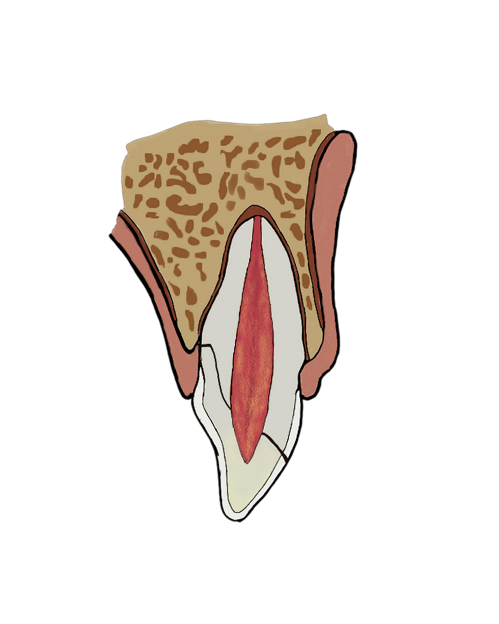 fraturacorono.png