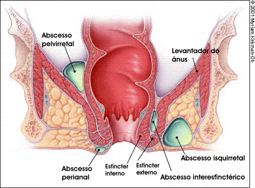 ABSCESSO-CLASSIF.gif