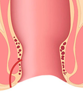 fistula-anal-1.jpg