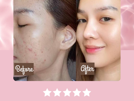 From Acne to Glow: Real Skin Transformations with Joju Collagen Plus