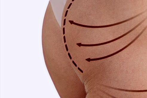 Woman's buttocks before and after plasti