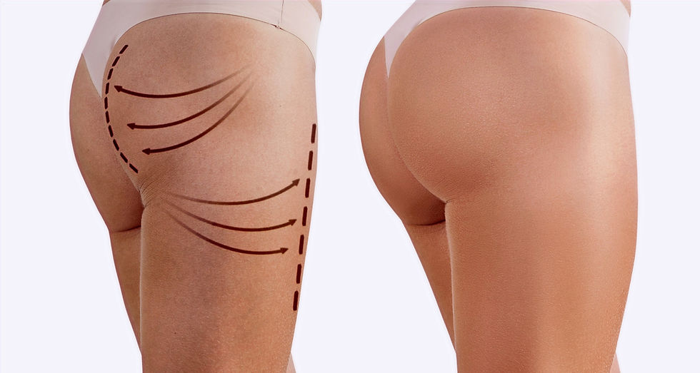 Popo Yağ Enjeksiyonu Namı Diğer BBL, Nedir Ne Değildir ?