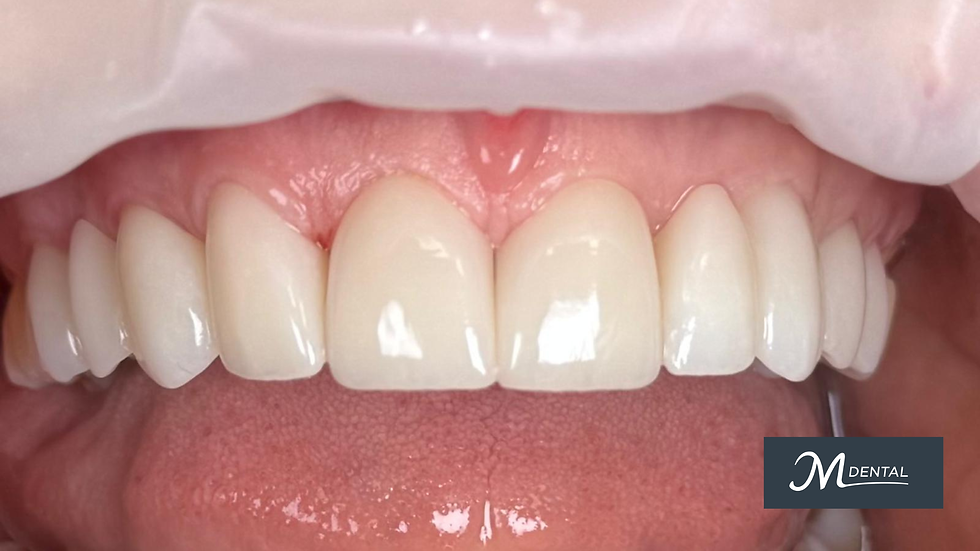 Cracked or Worn Front Teeth