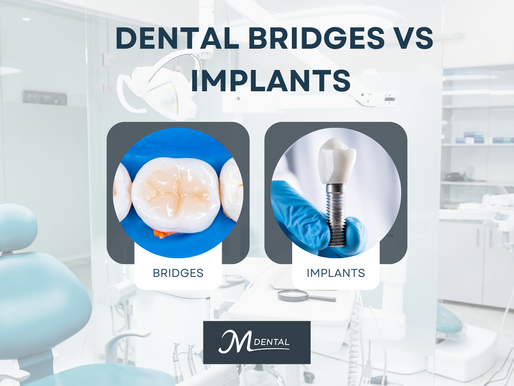 Dental Implants vs Bridges – Tooth Replacement in Canada Water SE16 - What are they and which is best?