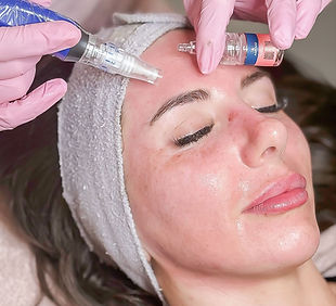 Microneedling Facial with Stem Cells