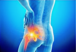 A computer-generated image of a hip and pelvis appearing in pain.