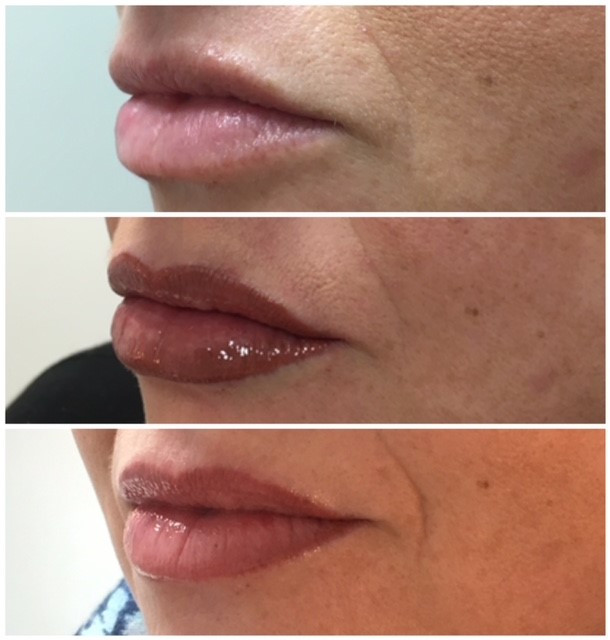 Permanent Lip Enhancement