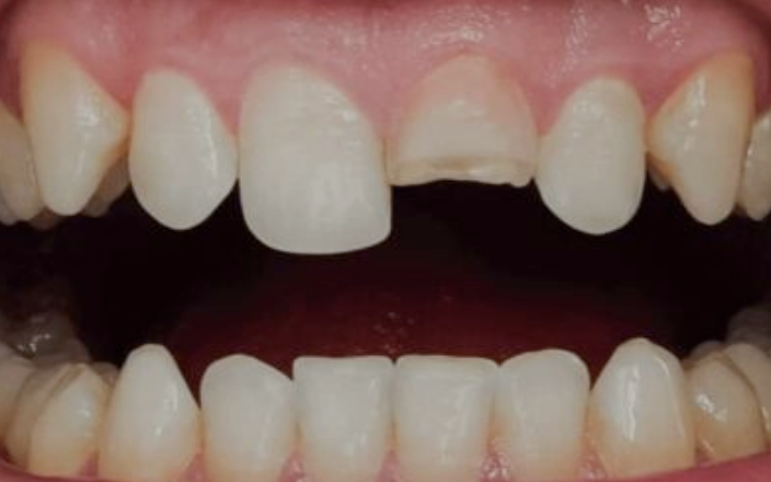 Thumbnail: Neomorph Mouthguards