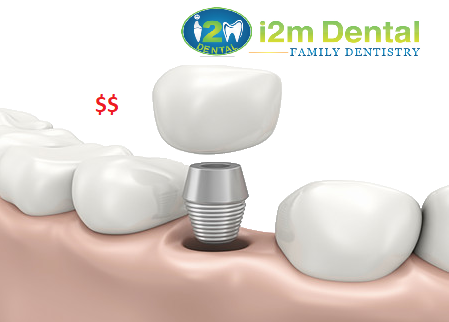 Cost of Dental Implant - i2m Dental