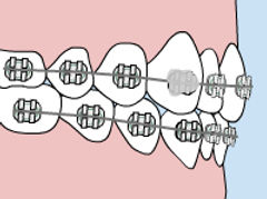 loose-bracket.jpg