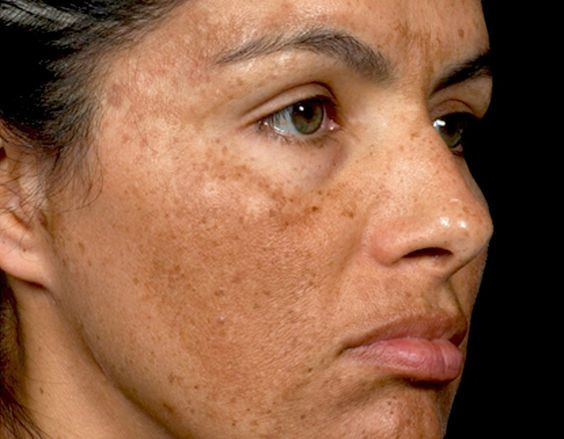 melasma on the entire face