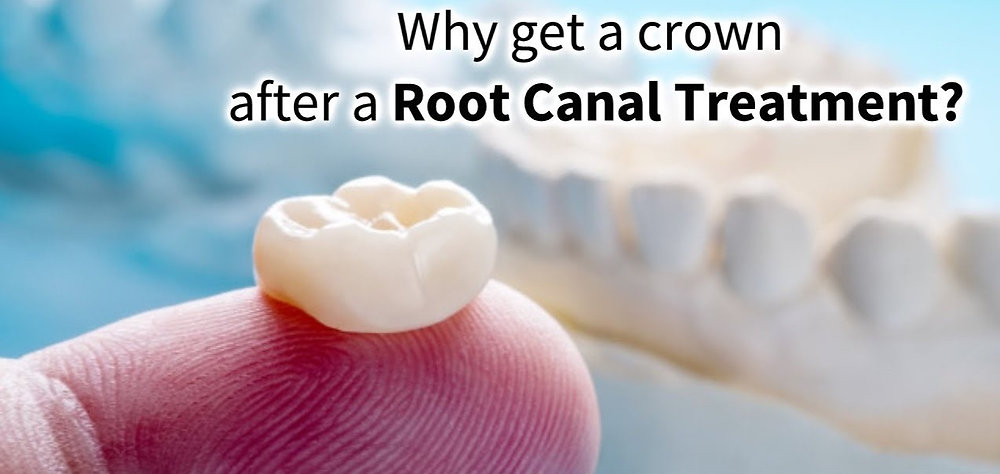 Crown | After Root Canal | RCT| Dental crown Required or Not?