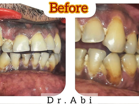 Teeth Whitening: Options, Side effect, Cost