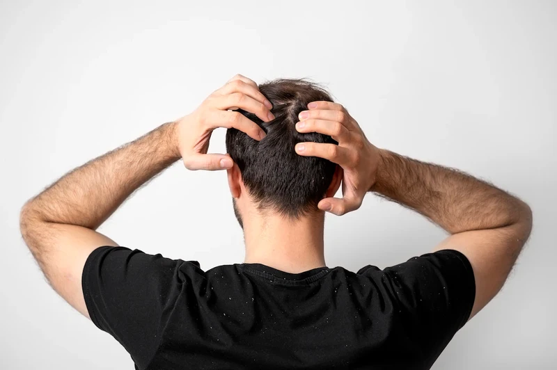 7 DAYS SPECIAL TREATMENTS FOR INTI- DANDRUFF AND ITCHY SCALP 