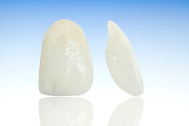 Veneers.jpg