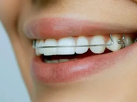 E aí, por quanto tempo a contenção deve ser usada?✨