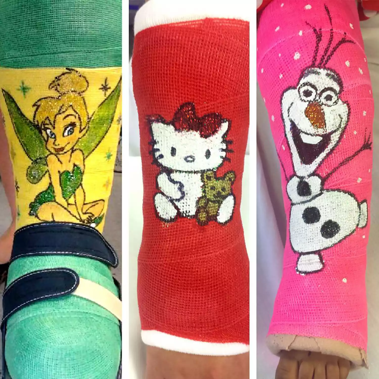 Happy faces drawn on childrens' hospital casts