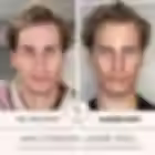 Hollywood Laser Peel Before & After